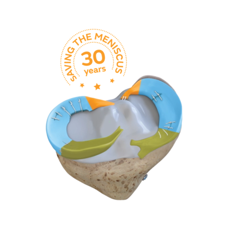 30 years meniscus.png