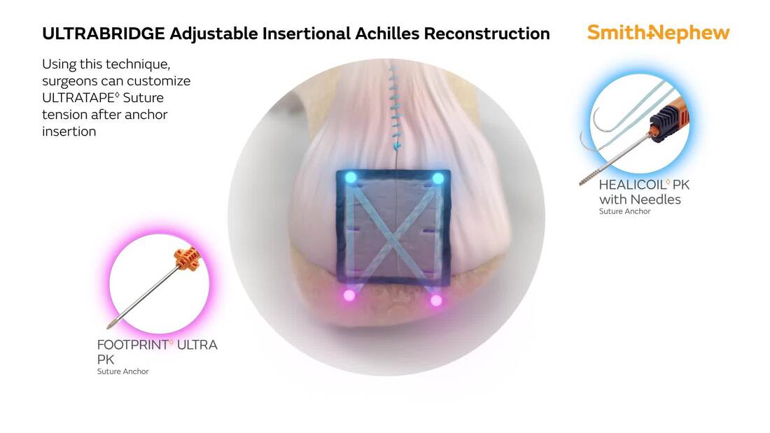 ULTRABRIDGE Adjustable Achilles Reconstruction with REGENETEN Bioinductive Implant