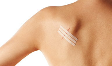 leukostrip-wound-closure-strips.jpg
