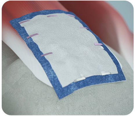 REGENETEN implant on RCR image from animation