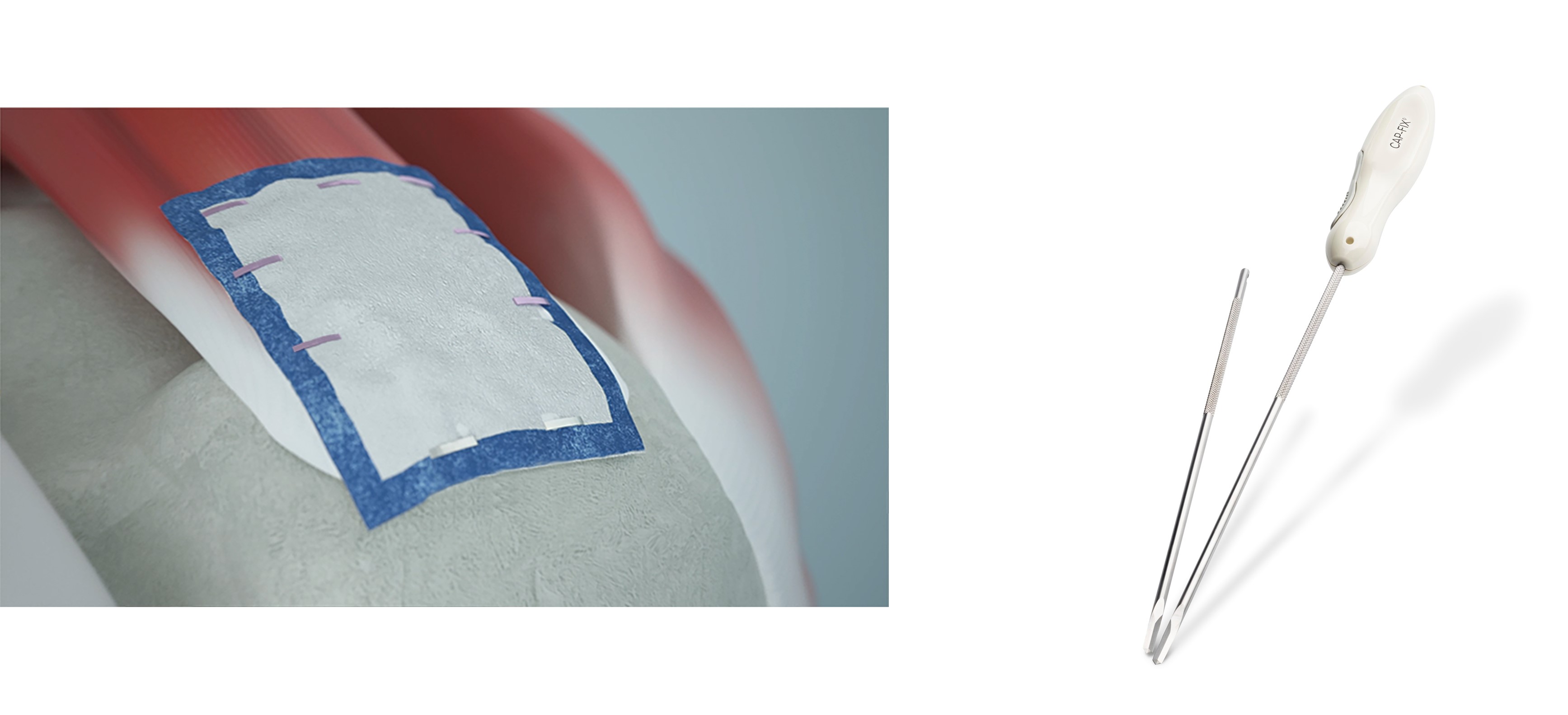 AOSSM 2022 REGENETEN CAPFIX.jpg