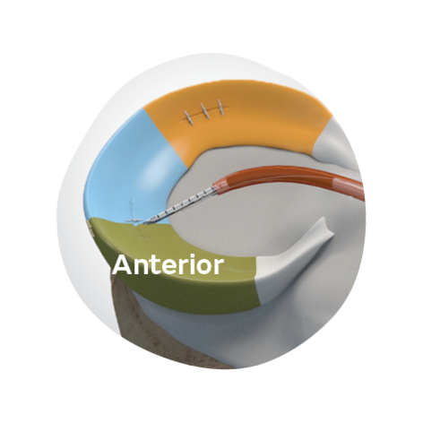 FAST-FIX FLEX Matisse