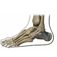 VLP FOOT Percutaneous Calcaneus Surgical Technique
