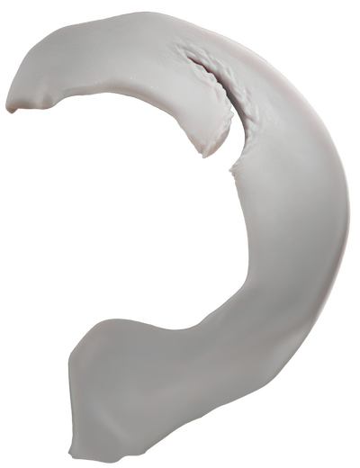 06_ParrotBeak_PreOp_Meniscus_01_01.png