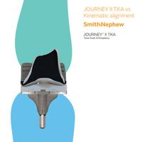JOURNEY II TKA vs Kinematic Alignment
