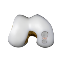 2-Condyle-multi-implant.png