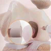 CARTIHEAL Surgical Technique Animation