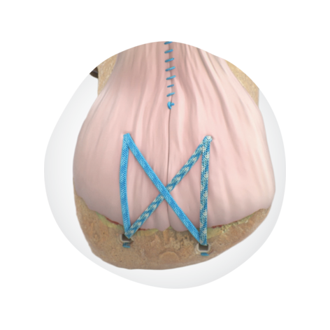 42372 Hero 2 ULTRABRIDGE.png