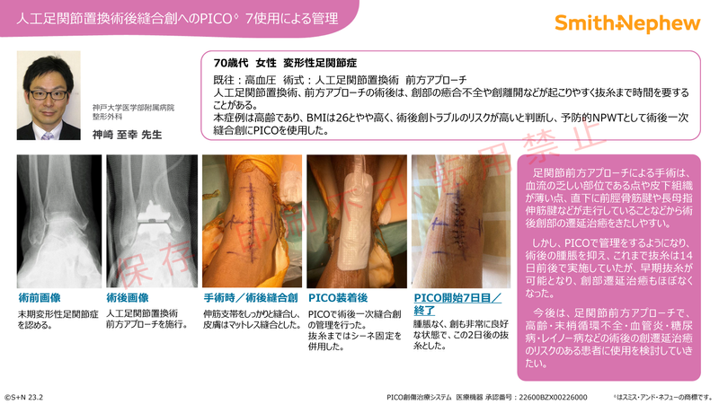 iPICO整形ケースカード_足首_神崎先生.png