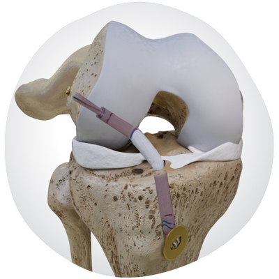 33747-V1-KNE-Ligament-Solutions.png