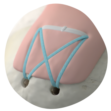 FullThicknessTear_HeroCutout(40062)_20250211