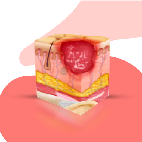 Ulcer Bundle.png