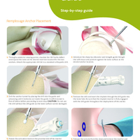 Q-FIX KNOTLESS Shoulder Technique Guide