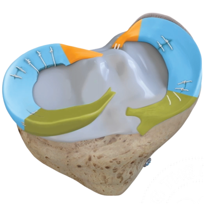 meniscus campaign_image