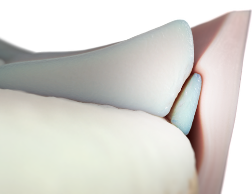 05_Ramp_PreOp_01_01.png