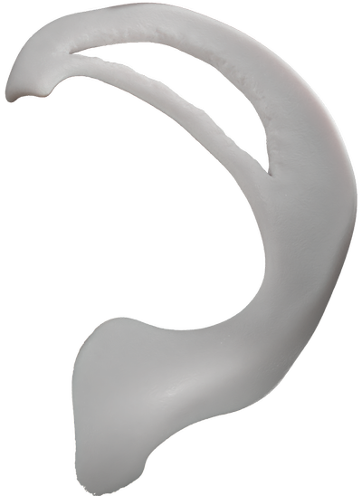 08_Bucket_Handle_PreOp_Meniscus_00000.png