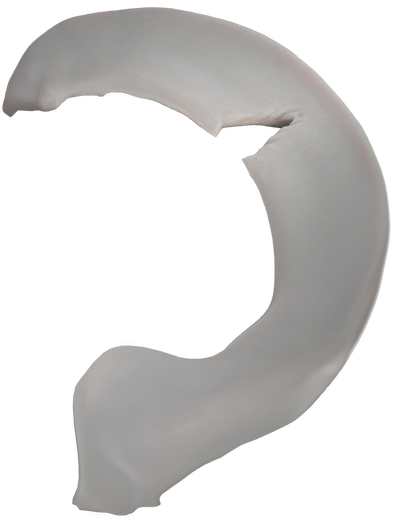 01_Radial_PreOp_Meniscus_01_01.png