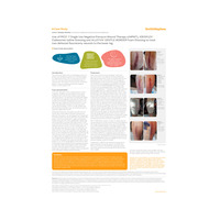 46815 ukinor PICO7+ALLEVYN GENTLE BORDER +IODOFLEX to treat two dehised fasciotomy wounds WCT Case Study 03-25.pdf