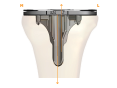 Optimized anatomic keel 117x88.png