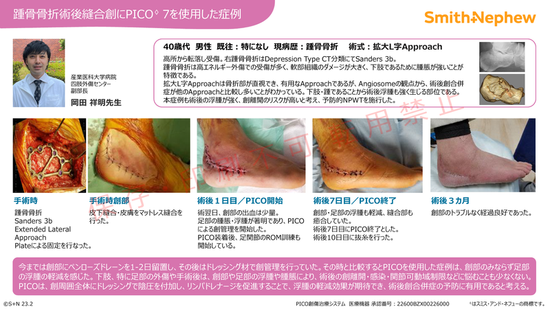 iPICO整形ケースカード_踵_岡田先生.png