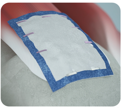 REGENETEN implant on RCR image from animation