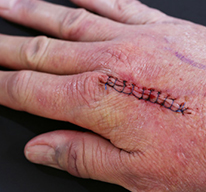wound-information-stitches.jpg