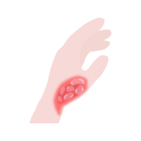 Icon - Consumer - Second Degree Burns