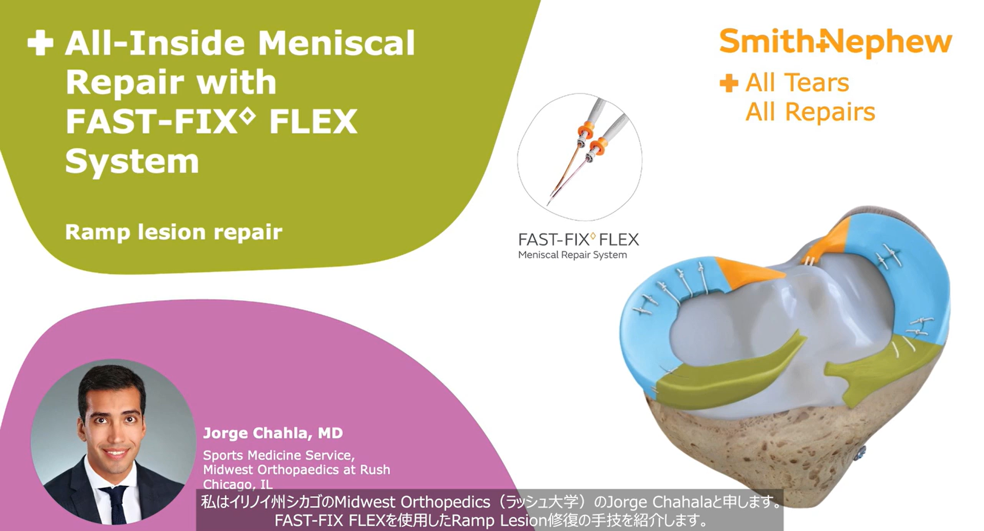 Meniscal ramp lesion with FAST-FIX FLEX