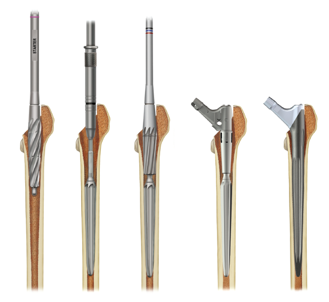 Redapt surgical steps