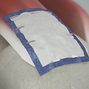 REGENTEN Patch Patient