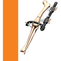 MODULAR RAIL SYSTEM Surgical Technique