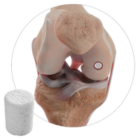 CARTIHEAL Procedure page Hero Image.png