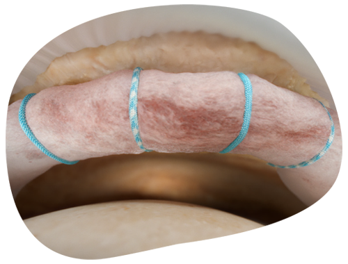 Hip Labrum Final Construct Image (QFKL)
