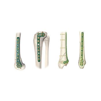 ZIMMER SMALL FRAGMENT SET プレート 骨手術セット（PERI-LOC Ti