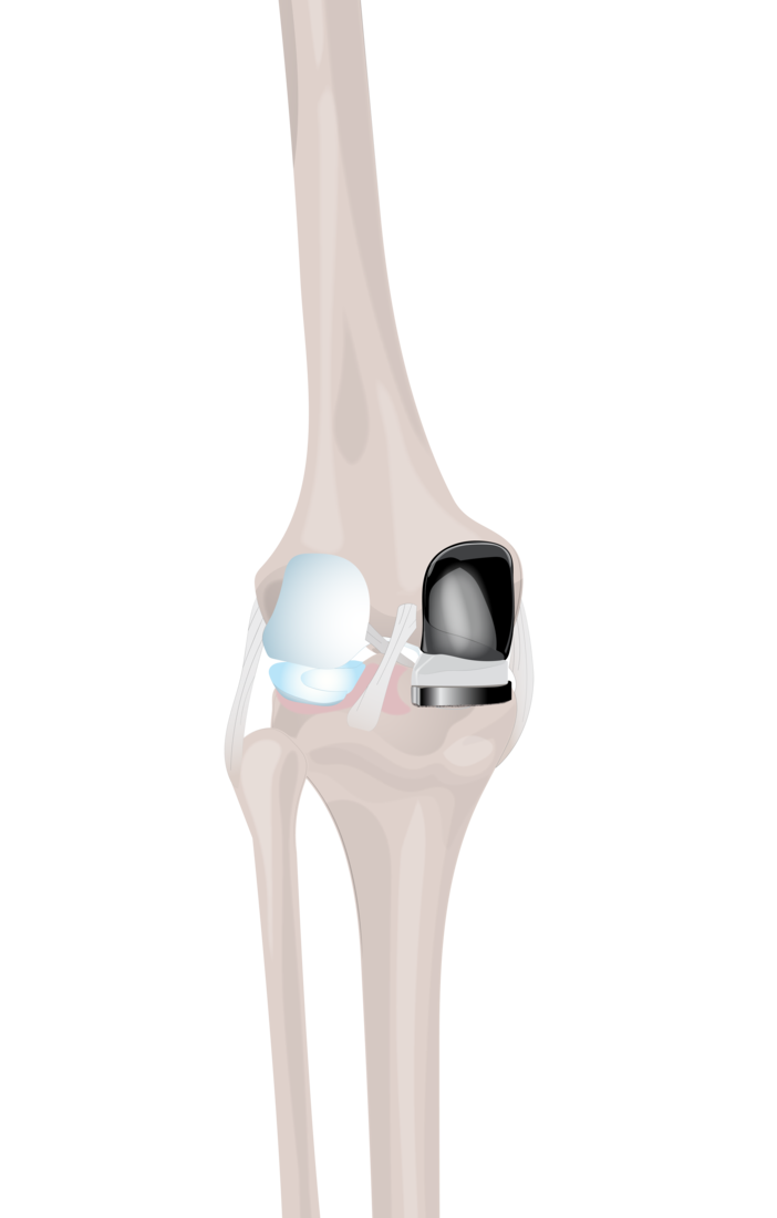 posterior uni impant.png