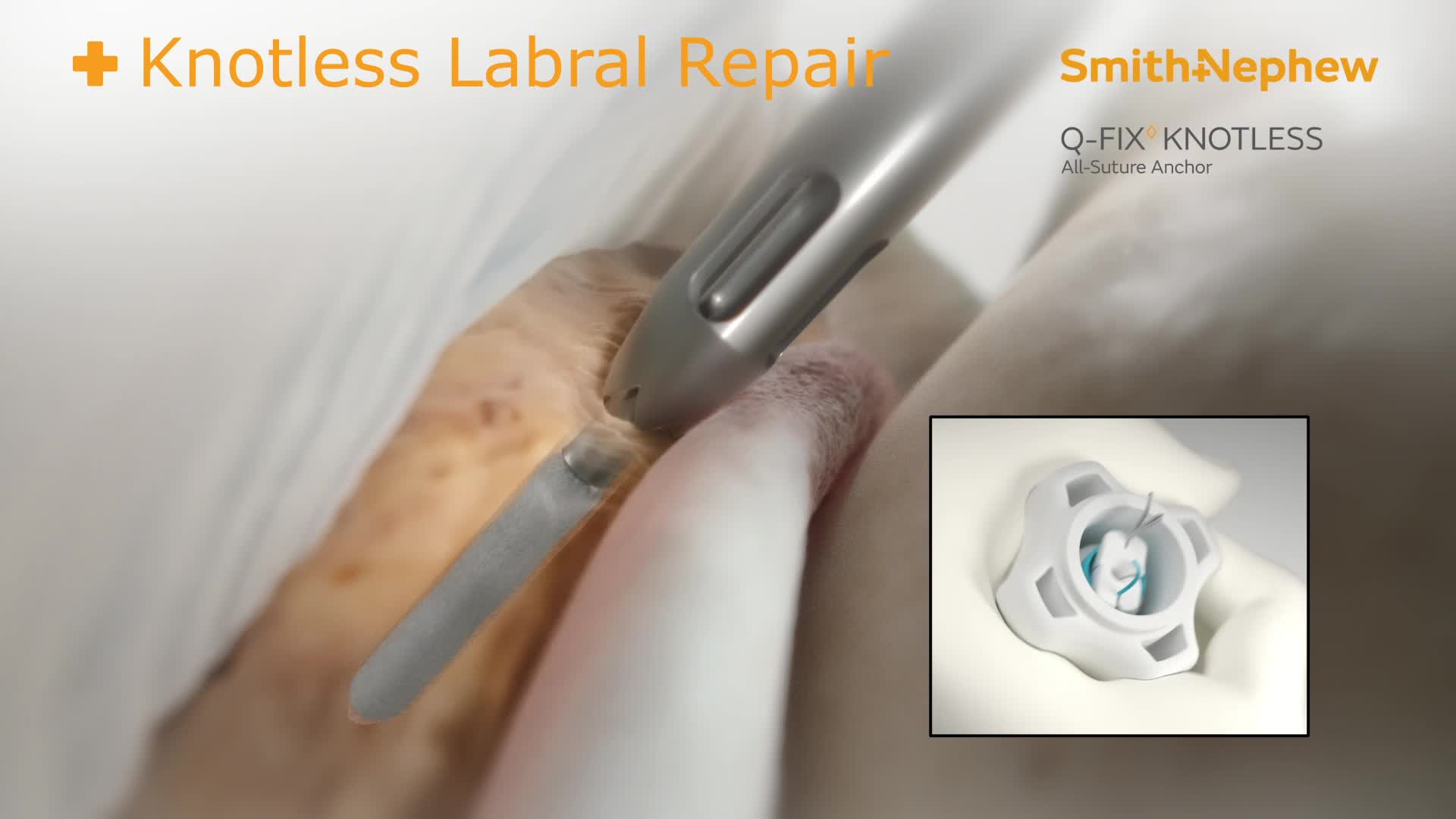 42618 Q-FIX KNOTLESS Hip Labral Animation Social Clip