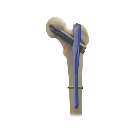 TRIGEN INTERTAN Hero 2.png