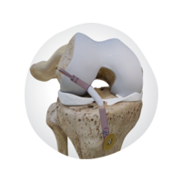 33747-V1-KNE-Ligament-Solutions.png