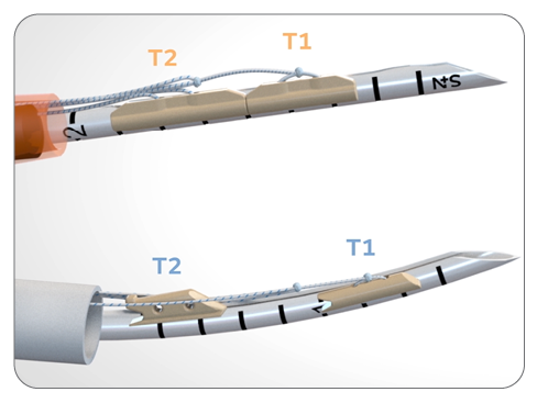 Preserve - FAST-FIX FLEX needle compare