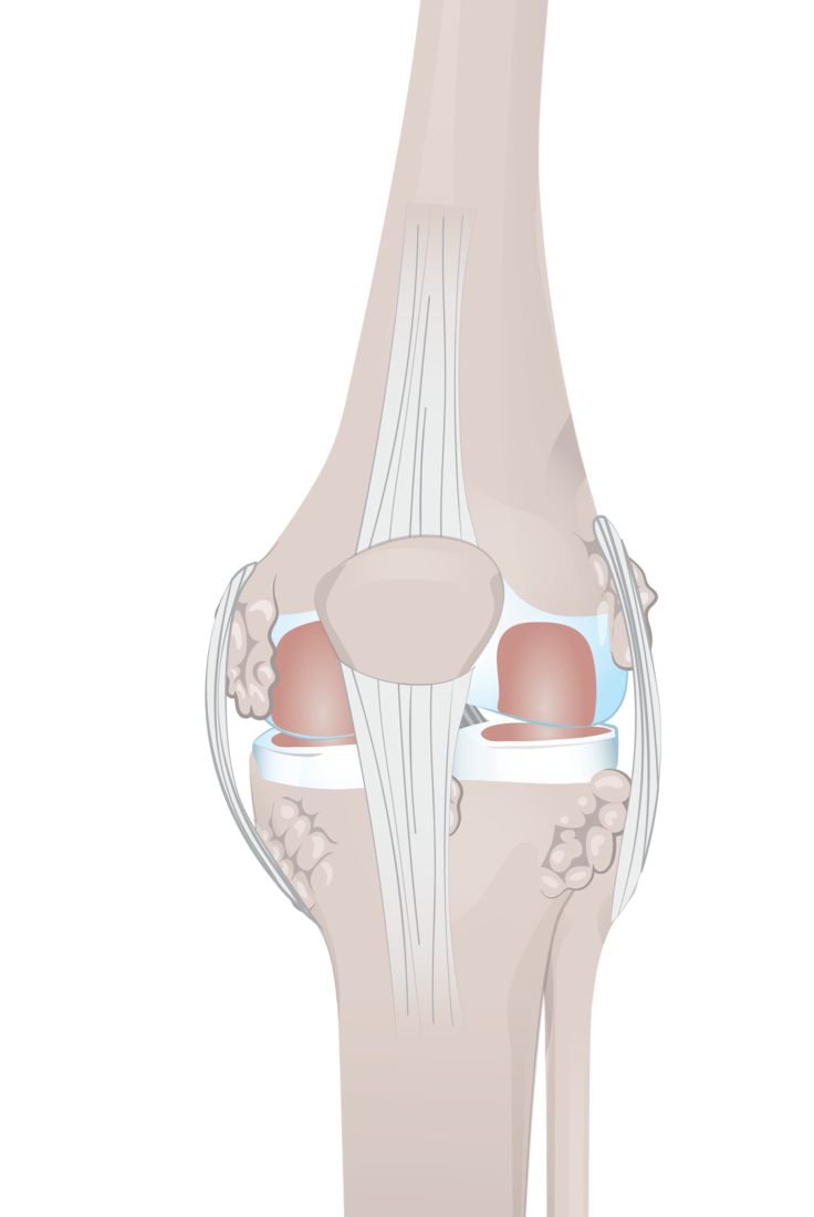 knee osteophytes-with patella.png