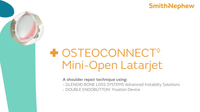 34958-V3-OSTEOCONNECT-Mini-Open-Latarjet-Animation 0823