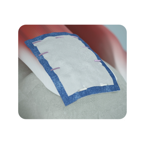 REGENETEN implant on RCR image from animation