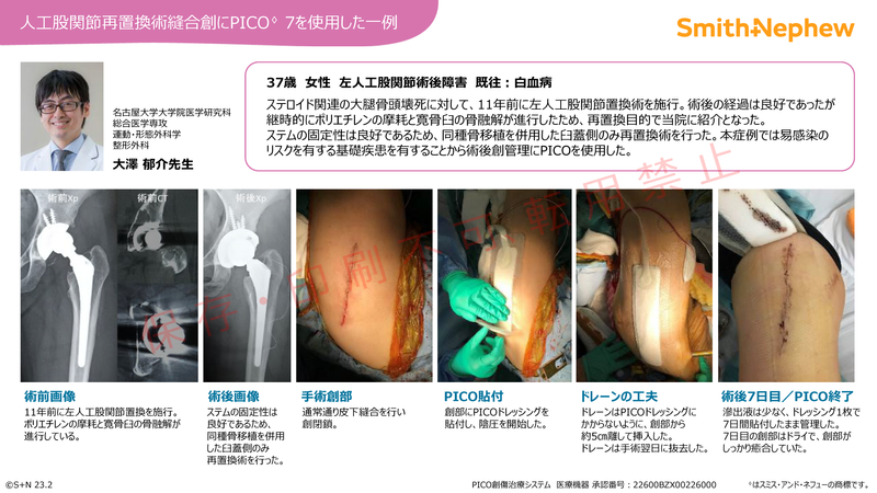 iPICO整形ケースカード_股関節_大澤先生.png