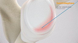 Q-FIX Knotless Bankart