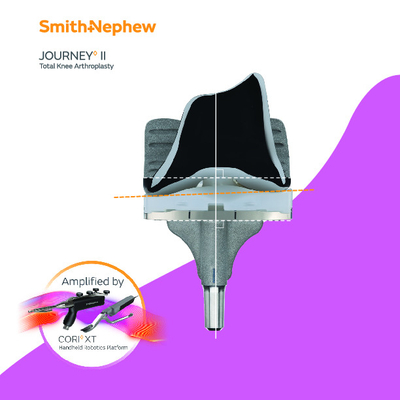 JOURNEY II TKA Personalized Alignment Brochure