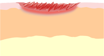 wound-heal-stage-1.png