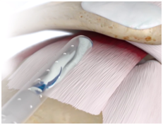 REGENETEN Insertion.png