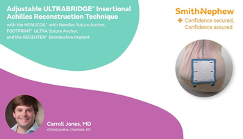 ULTRABRIDGE Insertional Achilles Reconstruction Technique with HEALICOIL with Needles featuring Dr. Jones