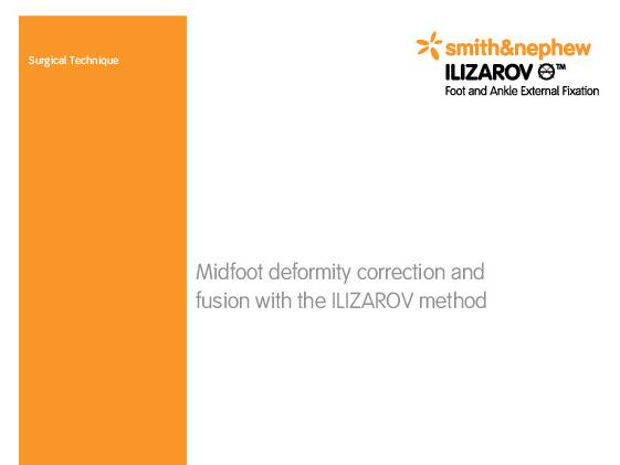 ILIZAROV Foot Ankle Mid-Foot Deformity Surgical Technique