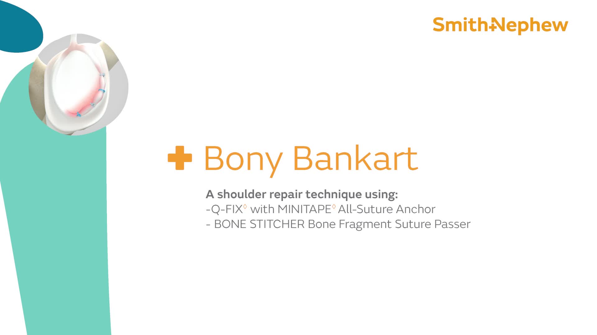 39333_V1_Bony_Bankart_Q_FIX_w_MINI_Animation_0823_mp4_1118889 (1).jpg
